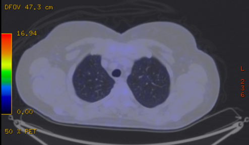 File:Cavitating lung mass - squamous cell carcinoma (Radiopaedia 48047-52853 A 23).png