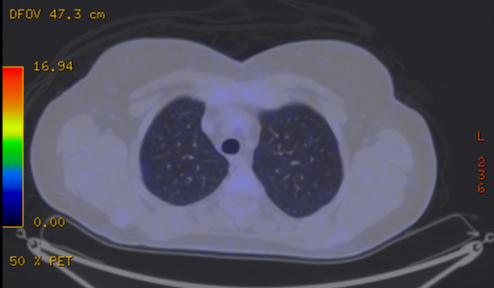 File:Cavitating lung mass - squamous cell carcinoma (Radiopaedia 48047-52853 A 25).png