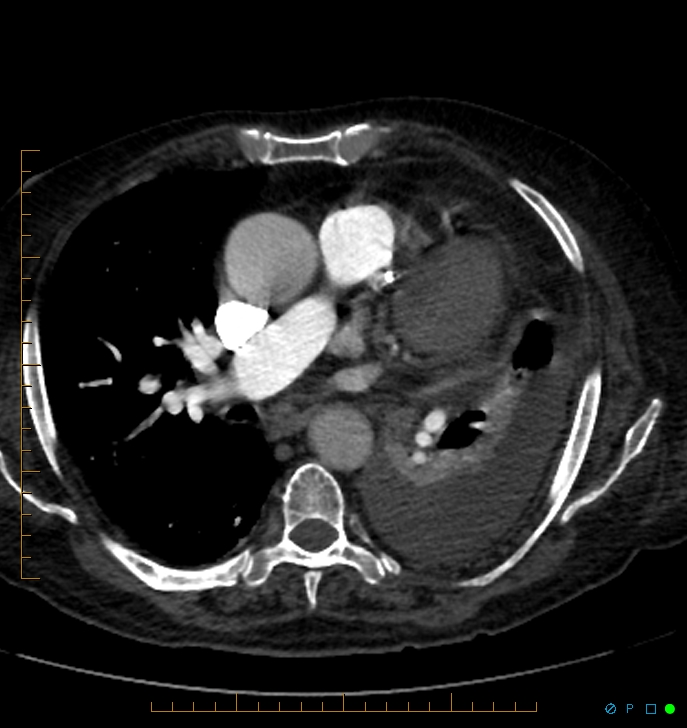 Cavitating pulmonary infarction (Radiopaedia 54634-60849 Axial C+ CTPA 40).jpg