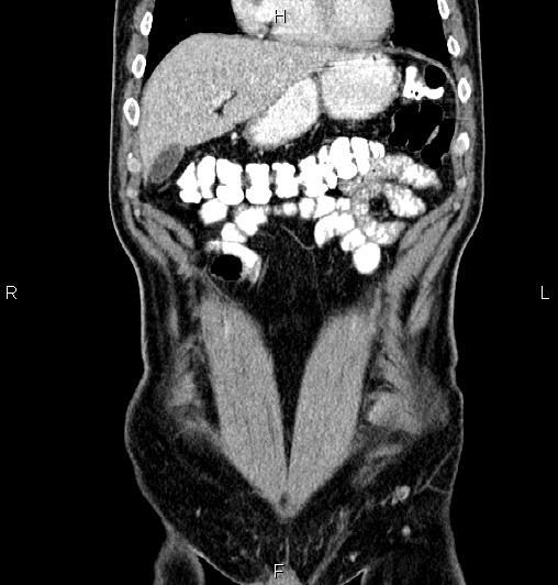 Cecal adenocarcinoma (Radiopaedia 85324-100916 D 14).jpg