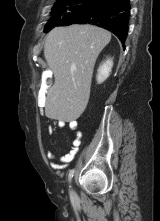 Cecal adenocarcinoma - surgical scar recurrence (Radiopaedia 79988-93264 D 49).jpg