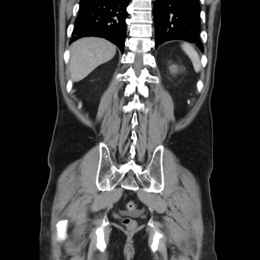 Cecal mass causing appendicitis (Radiopaedia 59207-66531 B 42).jpg