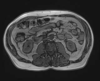 Cecal mass causing appendicitis (Radiopaedia 59207-66532 D 70).jpg