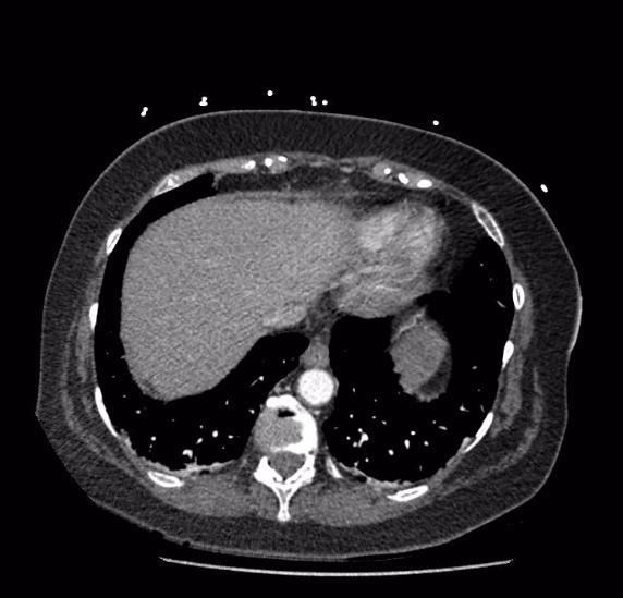 Celiac artery severe stenosis and dissection (Radiopaedia 44128-47842 B 3).jpg