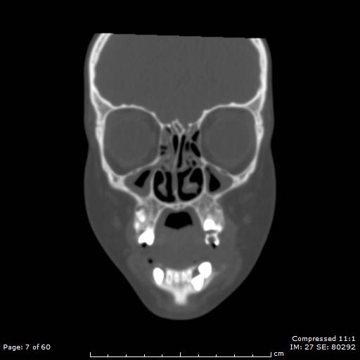 File:Central giant cell granuloma (Radiopaedia 45612-49754 Coronal bone window 7).jpg