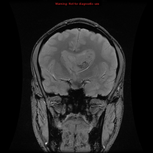 File:Central neurocytoma (Radiopaedia 13188-13206 G 11).jpg