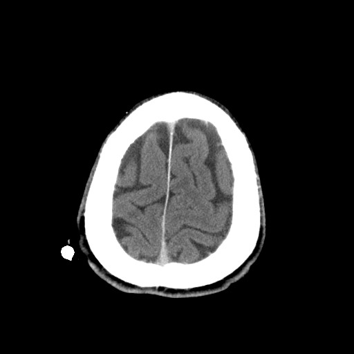 File:Central neurocytoma (Radiopaedia 68725-78432 Axial C+ 84).jpg
