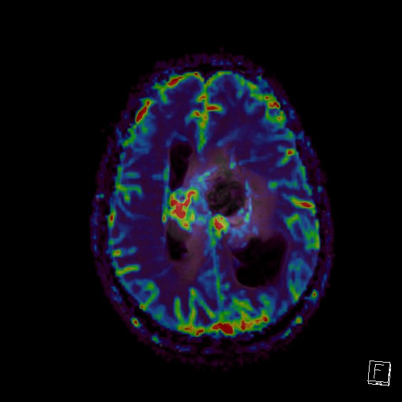 Central neurocytoma (Radiopaedia 84497-99872 Axial Perfusion 108).jpg