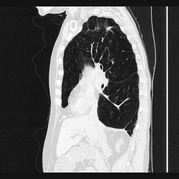 Centrilobular pulmonary emphysema (Radiopaedia 24495-24789 Sagittal lung window 34).jpg