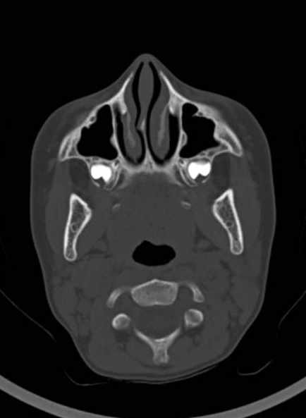 Cerebellar abscess (Radiopaedia 73727-84527 Axial bone window 11).jpg