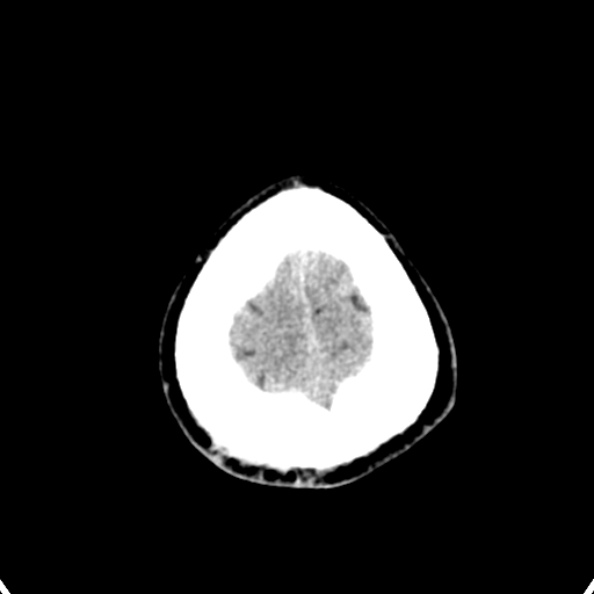 Cerebellar abscess secondary to mastoiditis (Radiopaedia 26284-26412 Axial non-contrast 147).jpg