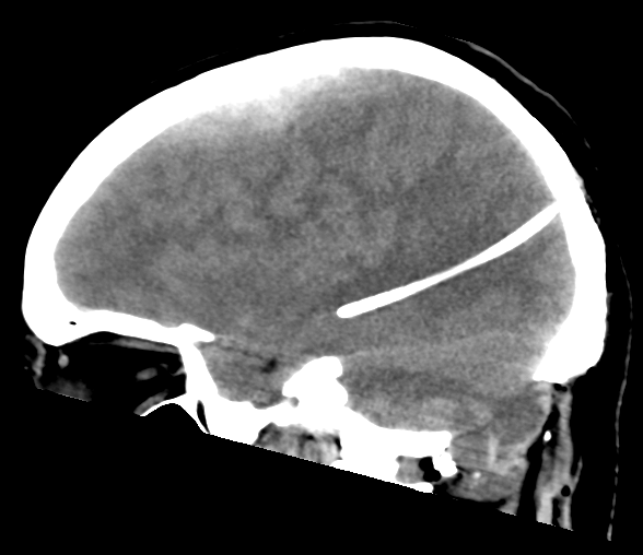 File:Cerebellar ependymoma complicated by post-operative subdural hematoma (Radiopaedia 83322-97737 C 11).png