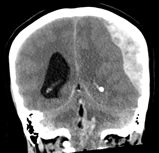 File:Cerebellar ependymoma complicated by post-operative subdural hematoma (Radiopaedia 83322-97737 Coronal non-contrast 25).png