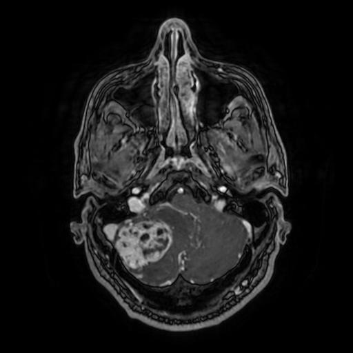 Cerebellar hemangioblastoma (Radiopaedia 88055-104622 Axial T1 C+ 45).jpg