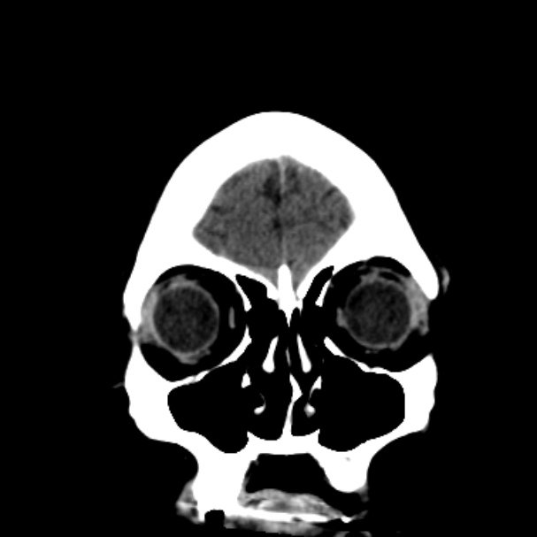 Cerebellar hemorrhage causing obstructive hydrocephalus (Radiopaedia 33989-35207 Coronal non-contrast 10).jpg