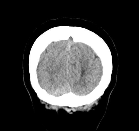 Cerebellar metastasis (Radiopaedia 54578-60812 Coronal non-contrast 55).png