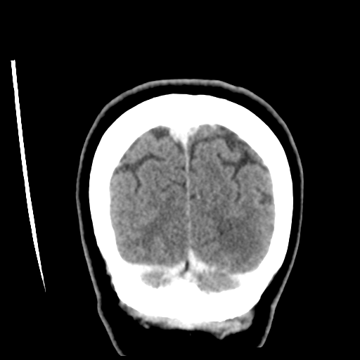 Cerebellar metastasis (cystic appearance) (Radiopaedia 41395-44258 D 54).png