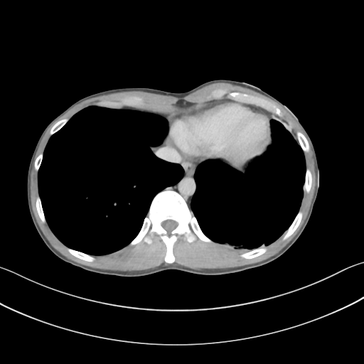 Cerebellar metastasis - adenocarcinoma lung (Radiopaedia 63184-71717 Axial C+ delayed 54).png
