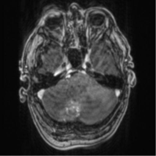 Cerebellar metastasis from lung adenocarcinoma (Radiopaedia 86690-102829 Axial T1 C+ 21).png