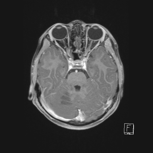 File:Cerebellar stroke (Radiopaedia 32202-33150 Axial T1 C+ 29).png