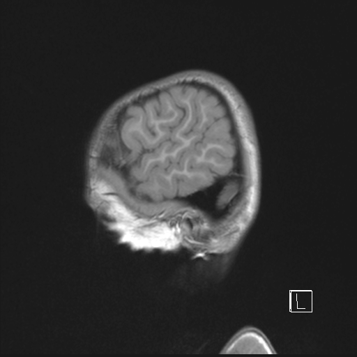 Cerebellar stroke (Radiopaedia 32202-33150 Sagittal T1 C+ 4).png