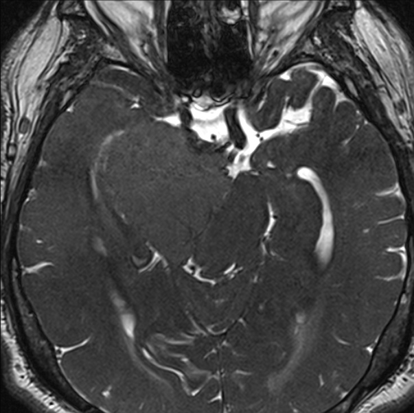Cerebellopontine angle meningioma (Radiopaedia 24459-24764 I 37).jpg