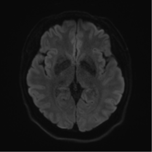 Cerebellopontine angle meningioma (Radiopaedia 48434-53348 Axial DWI 55).png