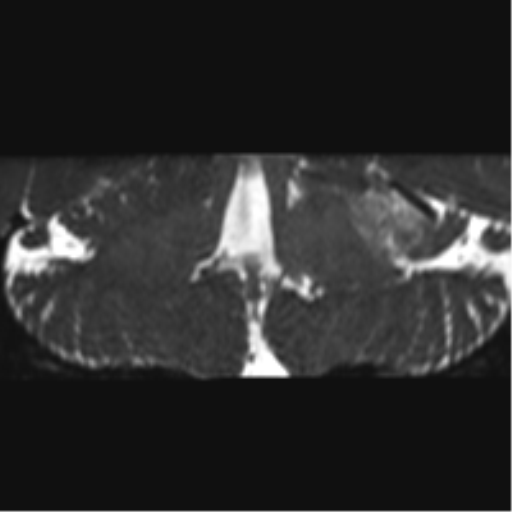 Cerebellopontine angle meningioma (Radiopaedia 48434-53348 Coronal T2 29).png
