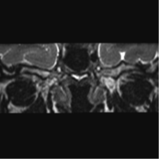Cerebellopontine angle meningioma (Radiopaedia 48434-53348 Coronal T2 82).png