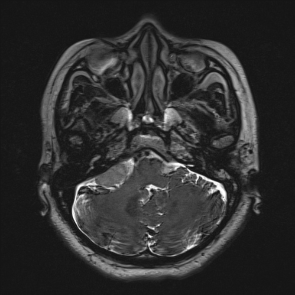 Cerebellopontine angle meningioma (Radiopaedia 53561-59591 Axial 3D volume T2 47).jpg