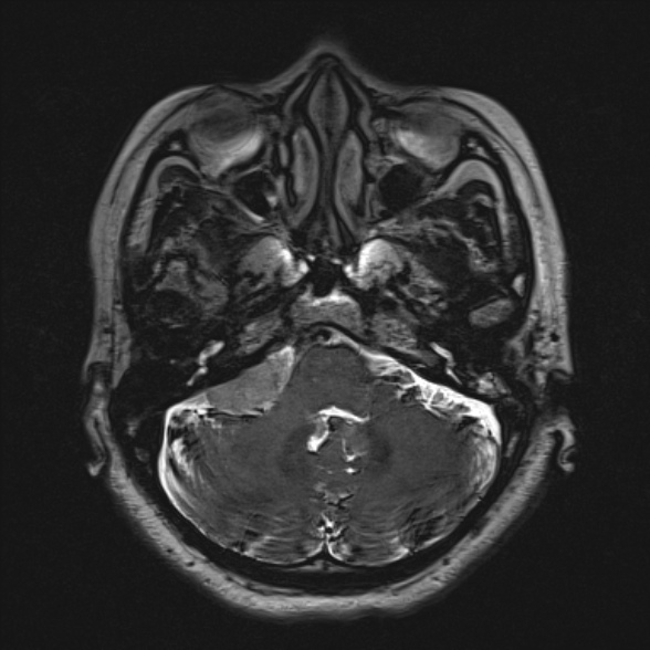 Cerebellopontine angle meningioma (Radiopaedia 53561-59591 Axial 3D volume T2 50).jpg