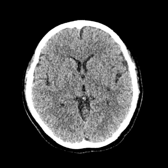 File:Cerebellopontine angle meningioma (Radiopaedia 53561-59592 Axial non-contrast 33).jpg