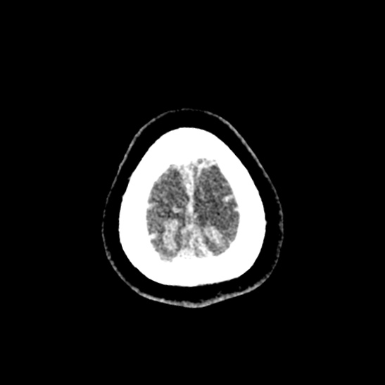 Cerebellopontine angle meningioma (Radiopaedia 53561-59592 Axial non-contrast 66).jpg