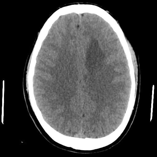 File:Cerebral abscess (Radiopaedia 29451-29919 Axial non-contrast 33).jpg