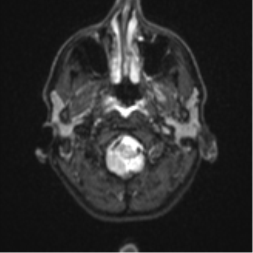 Cerebral abscess (Radiopaedia 60342-68009 Axial DWI 2).png