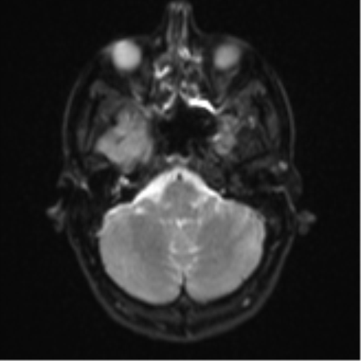 Cerebral abscess (Radiopaedia 60342-68009 Axial DWI 7).png