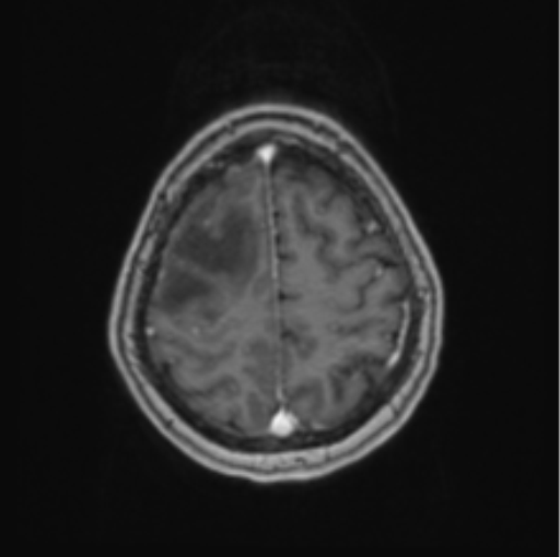 Cerebral abscess from pulmonary arteriovenous malformation (Radiopaedia 86275-102291 Axial T1 C+ 62).png
