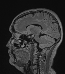 Cerebral abscess from pulmonary arteriovenous malformation (Radiopaedia 86275-102291 Sagittal FLAIR 32).png