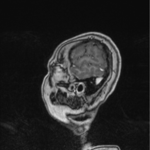 Cerebral abscess from pulmonary arteriovenous malformation (Radiopaedia 86275-102291 Sagittal T1 C+ 10).png