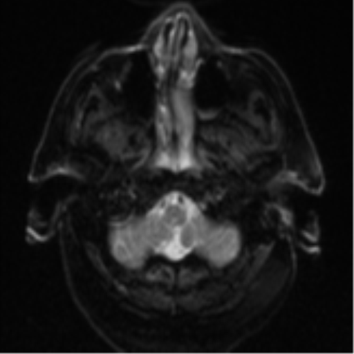 Cerebral abscesses- medically managed (Radiopaedia 45183-49179 Axial DWI 4).png