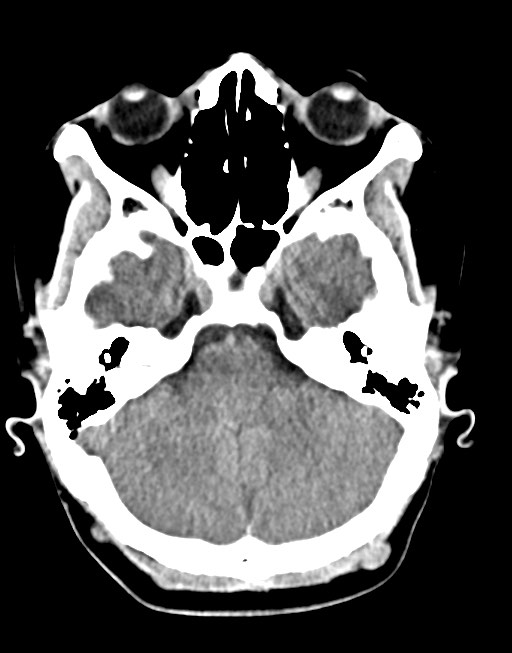 Cerebral abscesses (Radiopaedia 70458-80568 Axial non-contrast 18).jpg