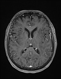 Cerebral amyloid angiopathy-related inflammation (Radiopaedia 58270-65377 Axial T1 C+ fat sat 78).jpg