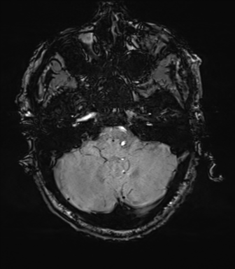 File:Cerebral amyloid angiopathy (Radiopaedia 46082-50433 Axial SWI 16).png