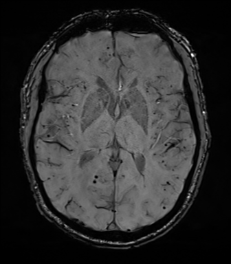 File:Cerebral amyloid angiopathy (Radiopaedia 46082-50433 Axial SWI 44).png