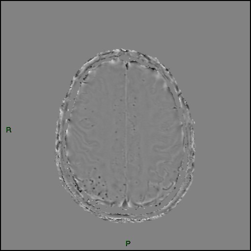 File:Cerebral amyloid angiopathy (Radiopaedia 77506-89664 H 76).jpg