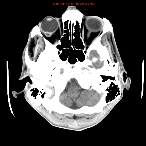 File:Cerebral and orbital tuberculomas (Radiopaedia 13308-13310 B 6).jpg