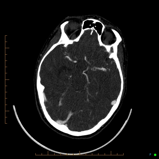 Cerebral arteriovenous malformation (AVM) (Radiopaedia 78162-90706 Axial CTA 116).jpg