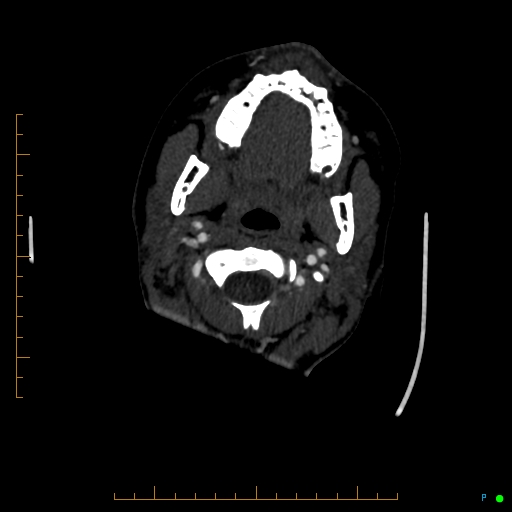 Cerebral arteriovenous malformation (AVM) (Radiopaedia 78162-90706 Axial CTA 16).jpg