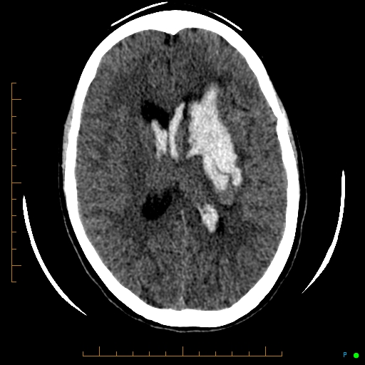 Cerebral arteriovenous malformation (AVM) (Radiopaedia 78162-90706 Axial non-contrast 38).jpg