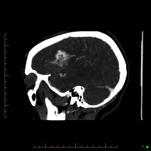 File:Cerebral arteriovenous malformation (AVM) (Radiopaedia 78162-90706 Sagittal CTA 21).jpg